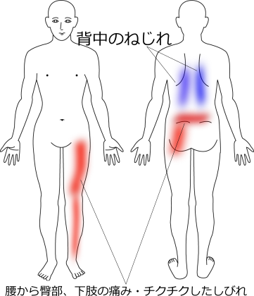 腰から下肢にかけてのしびれの症例画像