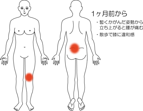 暫くかがんでから立ち上がると痛む腰痛の鍼灸施術症例画像