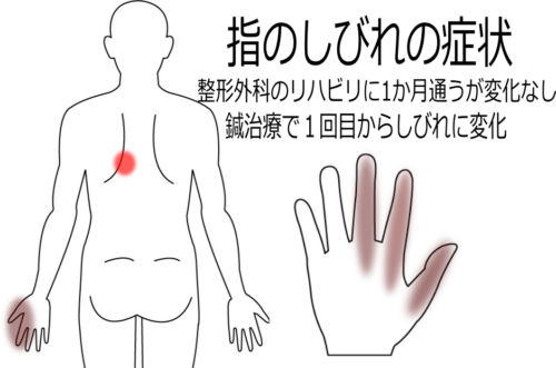 親指・人差し指・中指のしびれの鍼灸施術症例画像